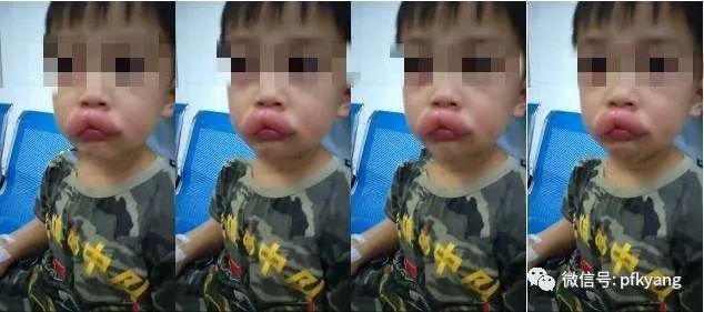 男孩吃葡萄过敏肿成嘟嘟嘴怎么回事？画面详情曝光网友忍不住笑了(图2)