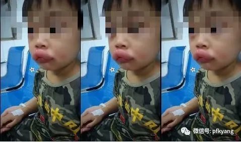男孩吃葡萄过敏肿成嘟嘟嘴怎么回事？画面详情曝光网友忍不住笑了
